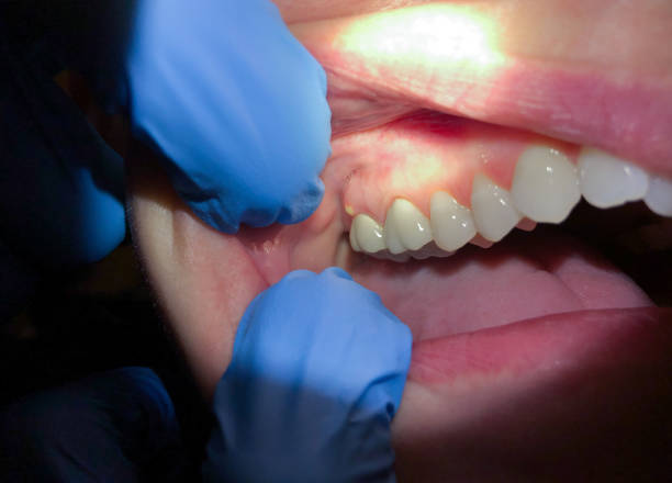 Best Broken Tooth Emergency  in Fort Oglethorpe, GA